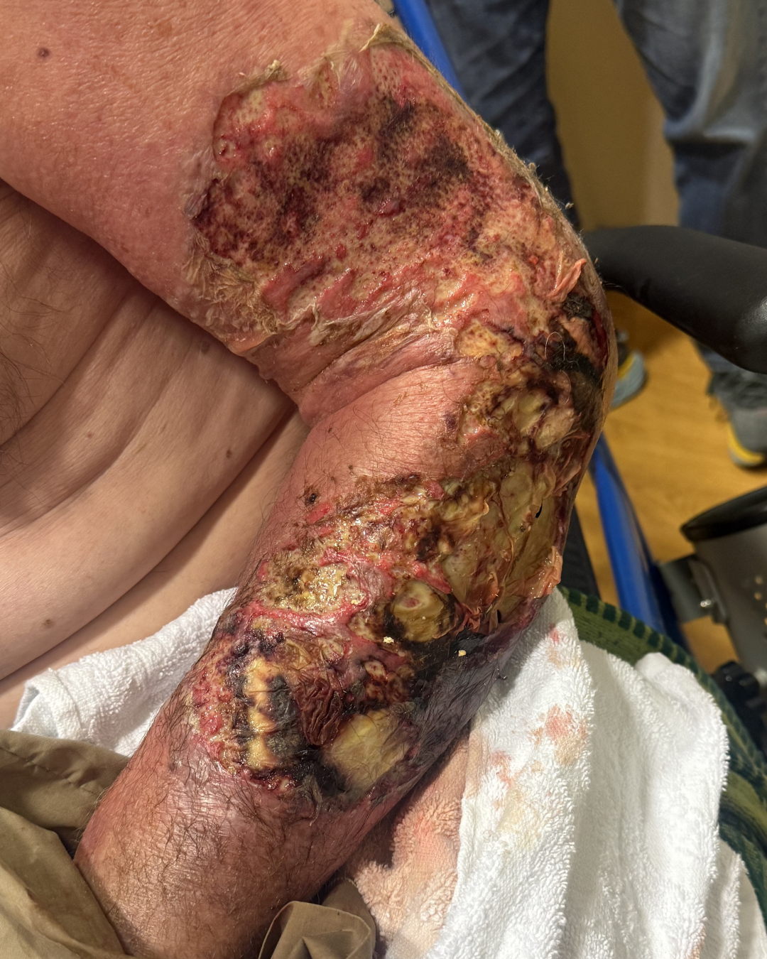 Severe traumatic soft-tissue injury to the arm immediately following a dog attack