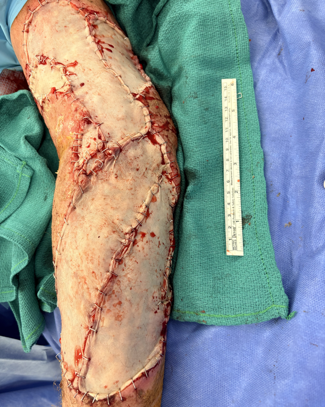 Arm immediately after definitive reconstructive coverage with skin grafting