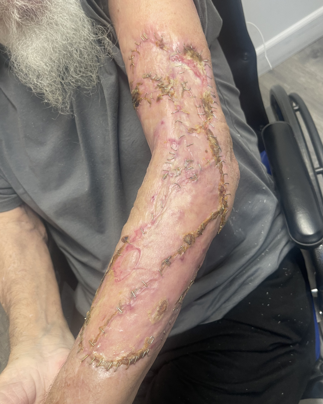 Reconstructed arm healing with staples in place at postoperative follow-up