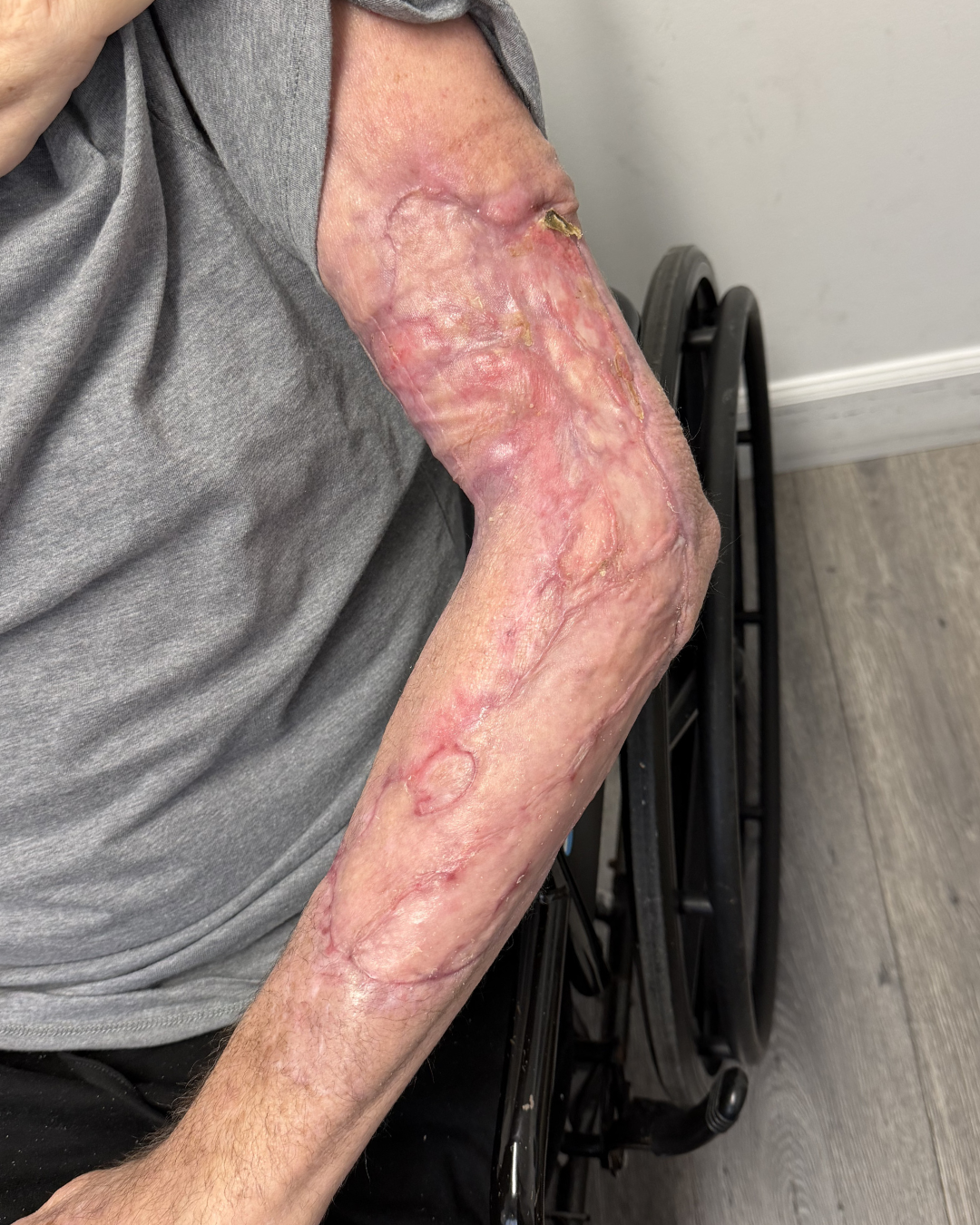 Reconstructed arm following staple removal with continued wound healing